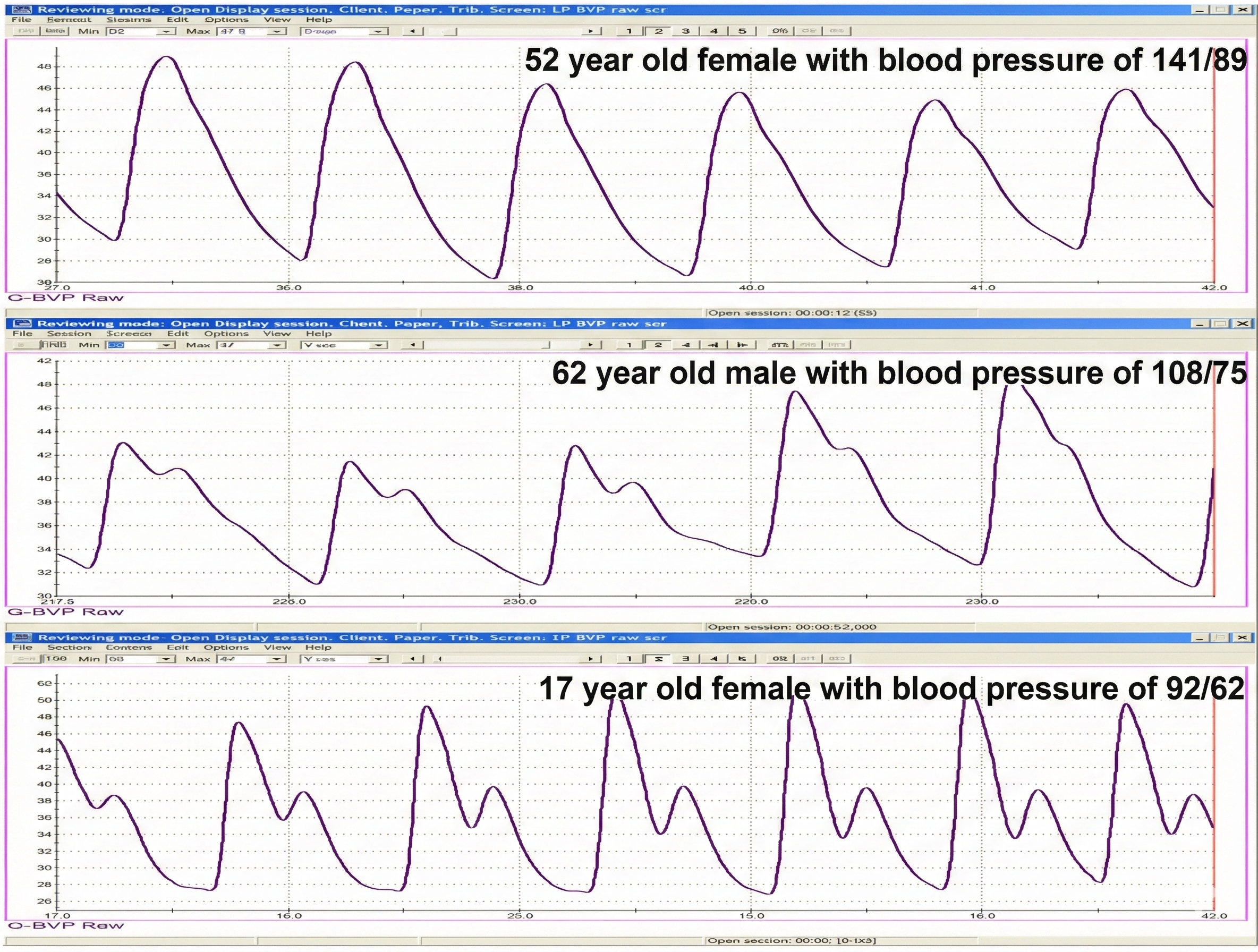 BVP and blood pressure comparison